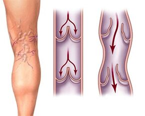 Normal operation of valves in a healthy vein and pathology of valves in varicose veins