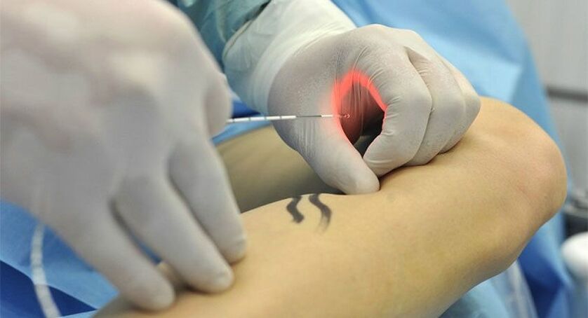 endovasal laser coagulation of blood vessels in varicose veins