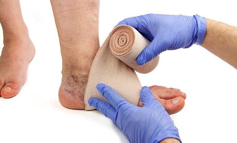 The treatment of varicose veins of the legs is complemented by the use of compression hosiery