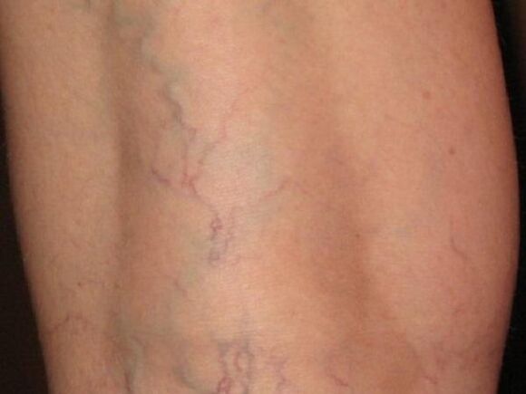 Varicose veins