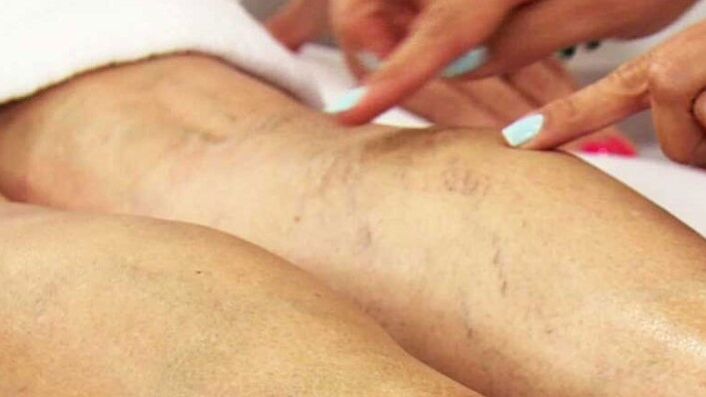 Varicose veins of the lower limbs