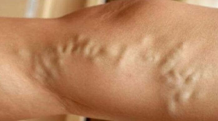 Different veins