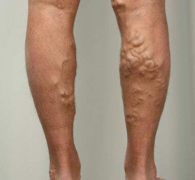 Different veins