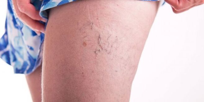 Different veins
