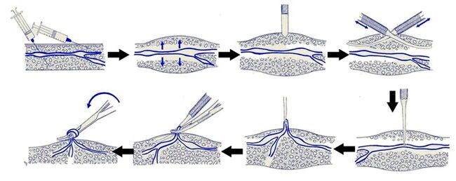 Varadi's surgery