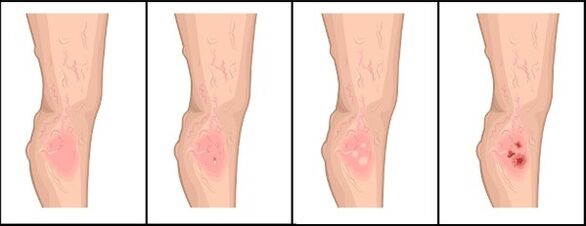 Varicose veins