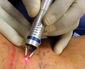 How is laser treatment of varicose veins performed