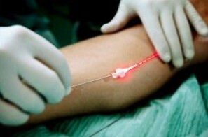 Laser treatment of varicose veins of the legs