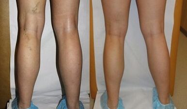 Laser treatment of varicose veins photo before and after