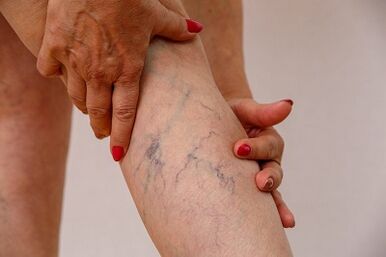 varicose veins of the lower limbs