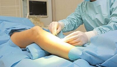 Under what symptoms is surgery for varicose veins prescribed