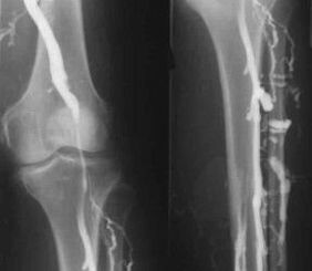 Possibilities for diagnosis of varicose veins of the limbs