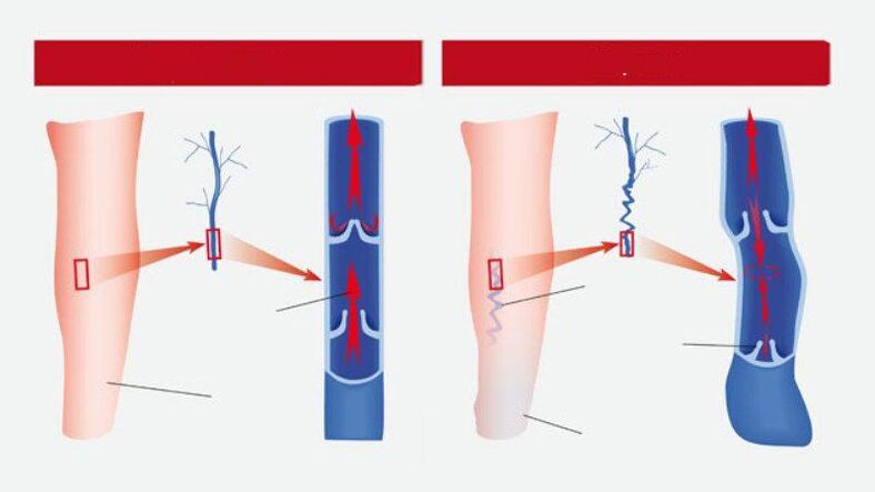 What varicose veins seem