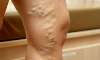 Signs and symptoms of varicose veins of the legs
